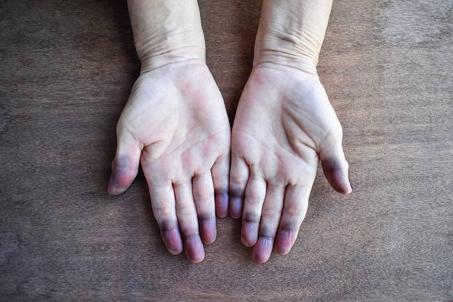 Methemoglobinemia in the hands